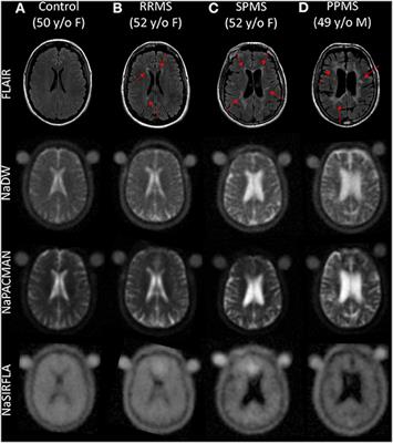 Sodium Intensity Changes Differ Between Relaxation- and Density-Weighted MRI in Multiple Sclerosis